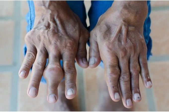 Giai đoạn gout mạn tính (Chronic Tophaceous Gout)