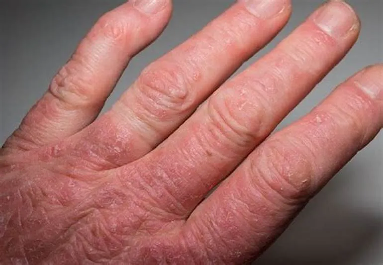 Tầm quan trọng của việc nhận biết sớm các dấu hiệu