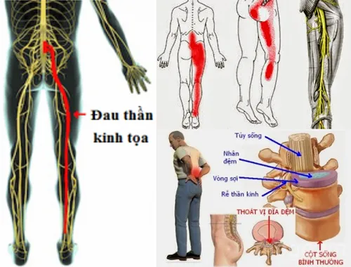 Triệu chứng thường gặp của đau thần kinh tọa