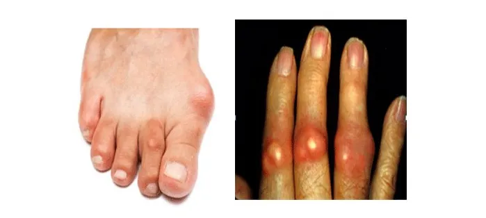 Tầm quan trọng của việc nhận biết sớm triệu chứng bệnh gout