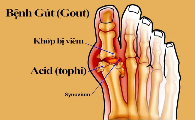 Bệnh gout: Khi axit uric "tấn công" khớp