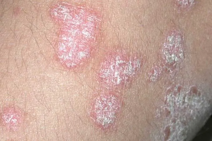 Viêm khớp vảy nến là gì và mối liên hệ với bệnh vảy nến