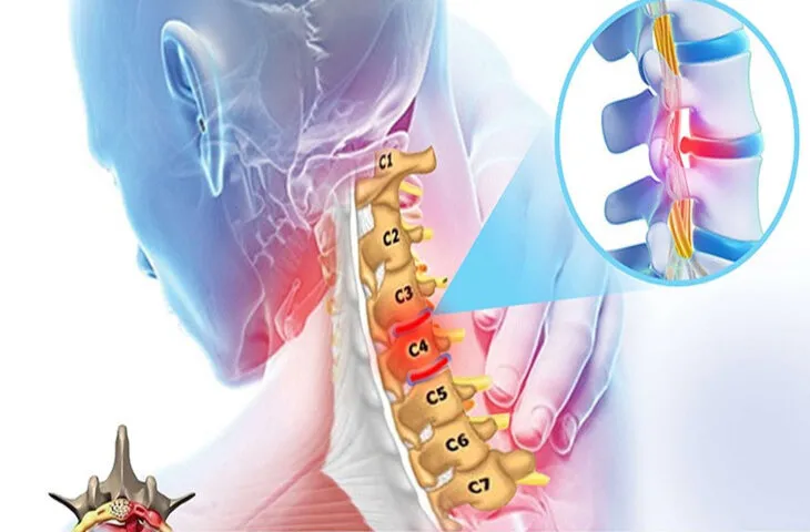 Triệu chứng thường gặp của thoát vị đĩa đệm cổ