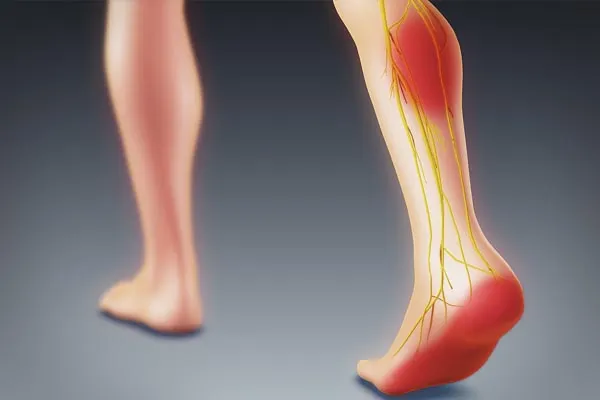 Chẩn đoán và điều trị đau thần kinh tọa
