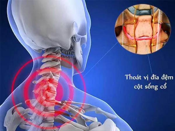 Thoát vị đĩa đệm cổ: Khi "lớp đệm" bị tổn thương