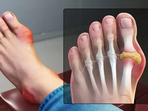 Triệu chứng của bệnh gout là gì?