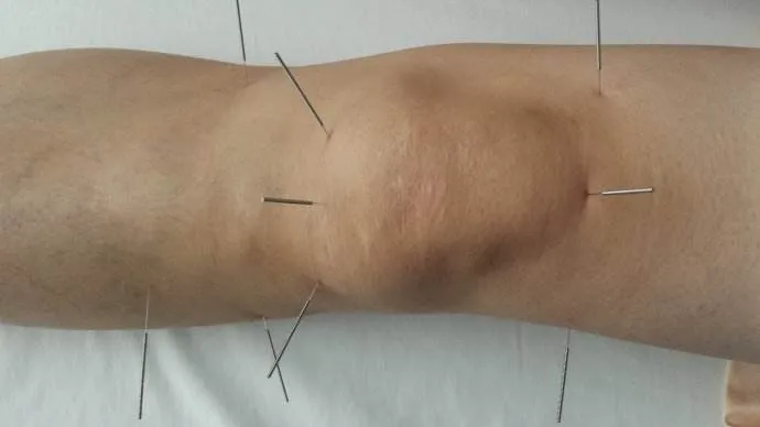 Những điều cần lưu ý khi chọn châm cứu chữa đau xương khớp