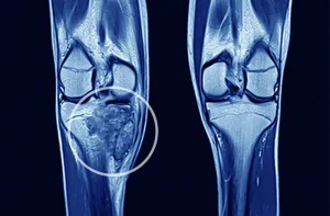 Bệnh loạn sản xương là gì?