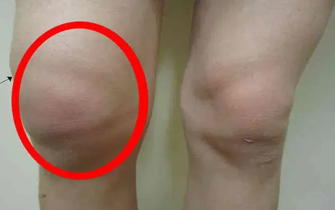 Triệu chứng của viêm bao hoạt dịch