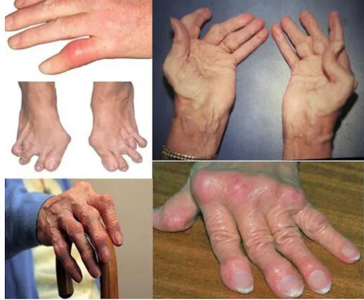 Các triệu chứng viêm khớp dạng thấp thường gặp ở nhiều vị trí trên cơ thể