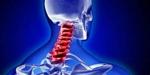 Thoái hóa cột sống cổ là gì?