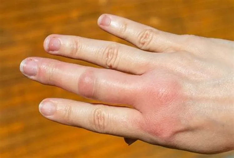 Sưng khớp ngón tay: Triệu chứng không nên bỏ qua
