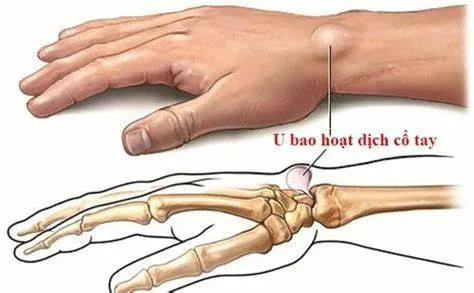 Viêm bao hoạt dịch (Bursitis)