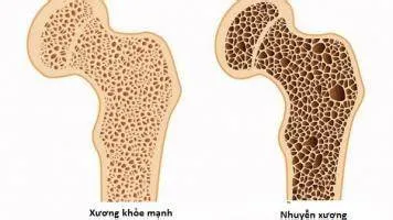 Còi xương ở người lớn (Nhuyễn xương) là gì?