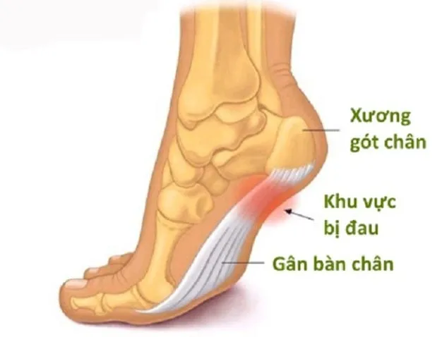 Các phương pháp điều trị viêm gân gót chân