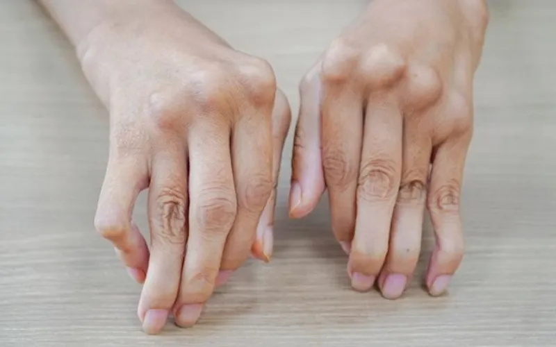 Nếu gia đình có người bị viêm khớp dạng thấp, tôi có nguy cơ cao không?