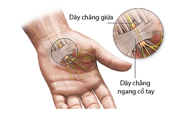 Hội chứng ống cổ tay: Khi dây thần kinh bị chèn ép