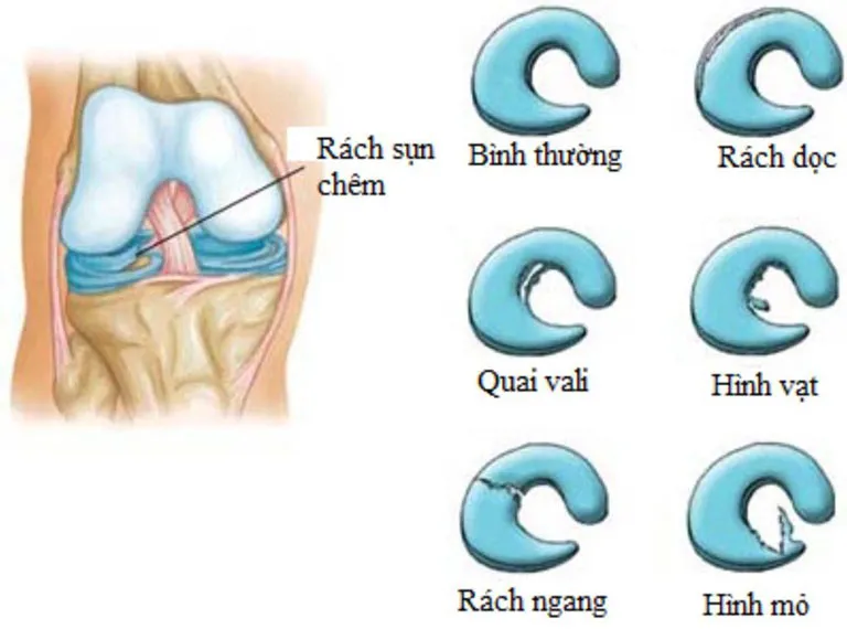 Rách Sụn Chêm: "Vết Rạn" Bên Trong Khớp Gối