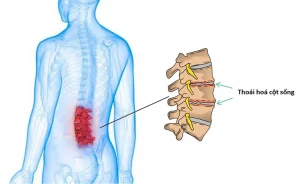 Điều trị thoái hóa cột sống thắt lưng