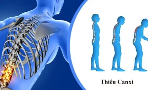 Dấu hiệu thiếu canxi ở người lớn