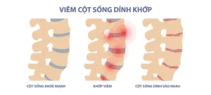 Bệnh viêm cột sống dính khớp là gì?