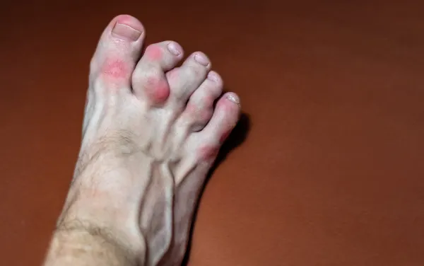 Bệnh Gout: "Kẻ Gây Đau" Từ Axit Uric