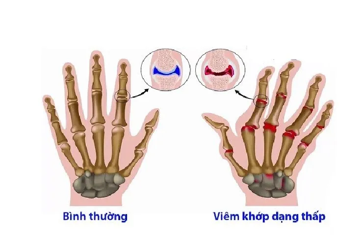 Tầm quan trọng của việc nhận biết sớm các triệu chứng