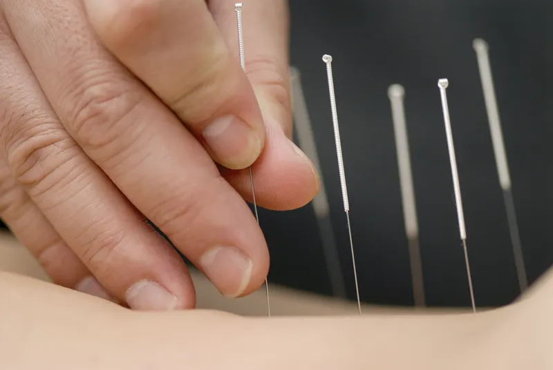 Châm cứu là gì và nó hoạt động như thế nào?