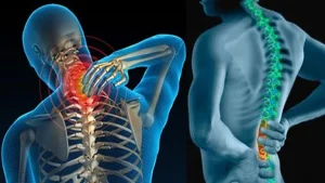 Gai cột sống có nguy hiểm không?