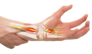 Hội chứng ống cổ tay là gì?