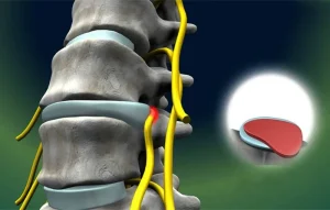Cách phục hồi sau mổ thoát vị đĩa đệm