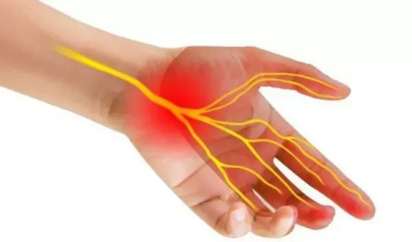 Triệu chứng của hội chứng ống cổ tay