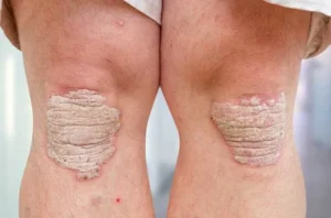 Cách nhận biết viêm khớp vảy nến?