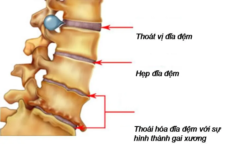 Đĩa đệm cột sống là gì?