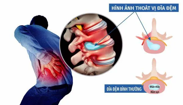 Các yếu tố nguy cơ làm tăng khả năng bị thoát vị đĩa đệm
