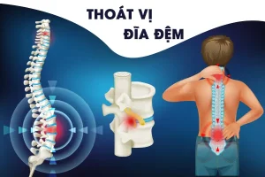 Thoát vị đĩa đệm cổ là gì?