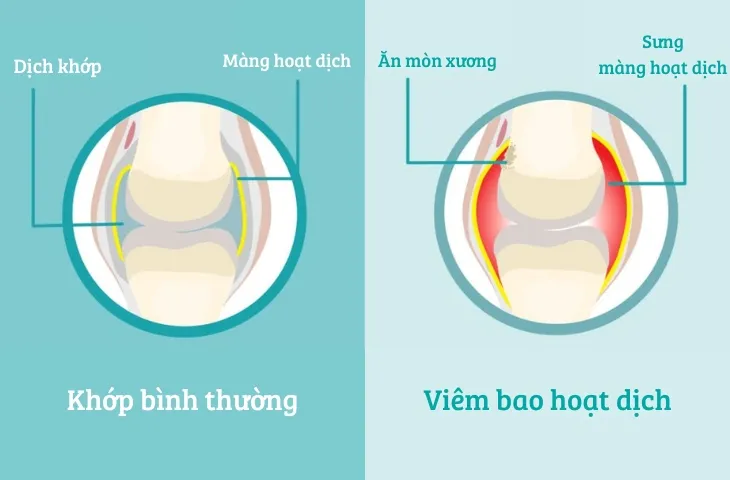 Bao hoạt dịch là gì và vai trò của nó trong cơ thể?