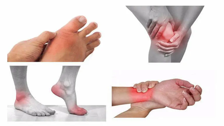 Viêm khớp nhiễm khuẩn: Khi khớp bị "tấn công" bởi vi sinh vật
